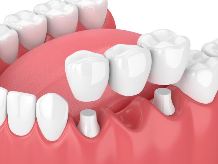 The Importance of Crowns in Dentistry